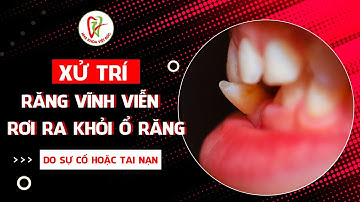Xử Trí Răng Vĩnh Viễn Rơi Ra Khỏi Ổ Răng Do Tai Nạn
