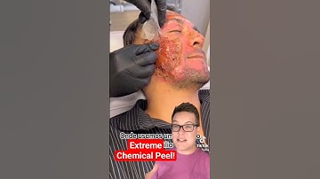 SHOCKING CHEMICAL PEEL - Phenol Peel Results #shorts