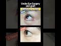 Improve Scar Removal And Sagging Under The Eyes At The Same Time 