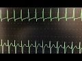 Name that EKG rhythm