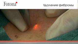 FT лазерное удаление новообразований FT лазерное удаление новообразований