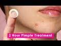 2 Hour Pimple Sticker- Does it Work? 🤔