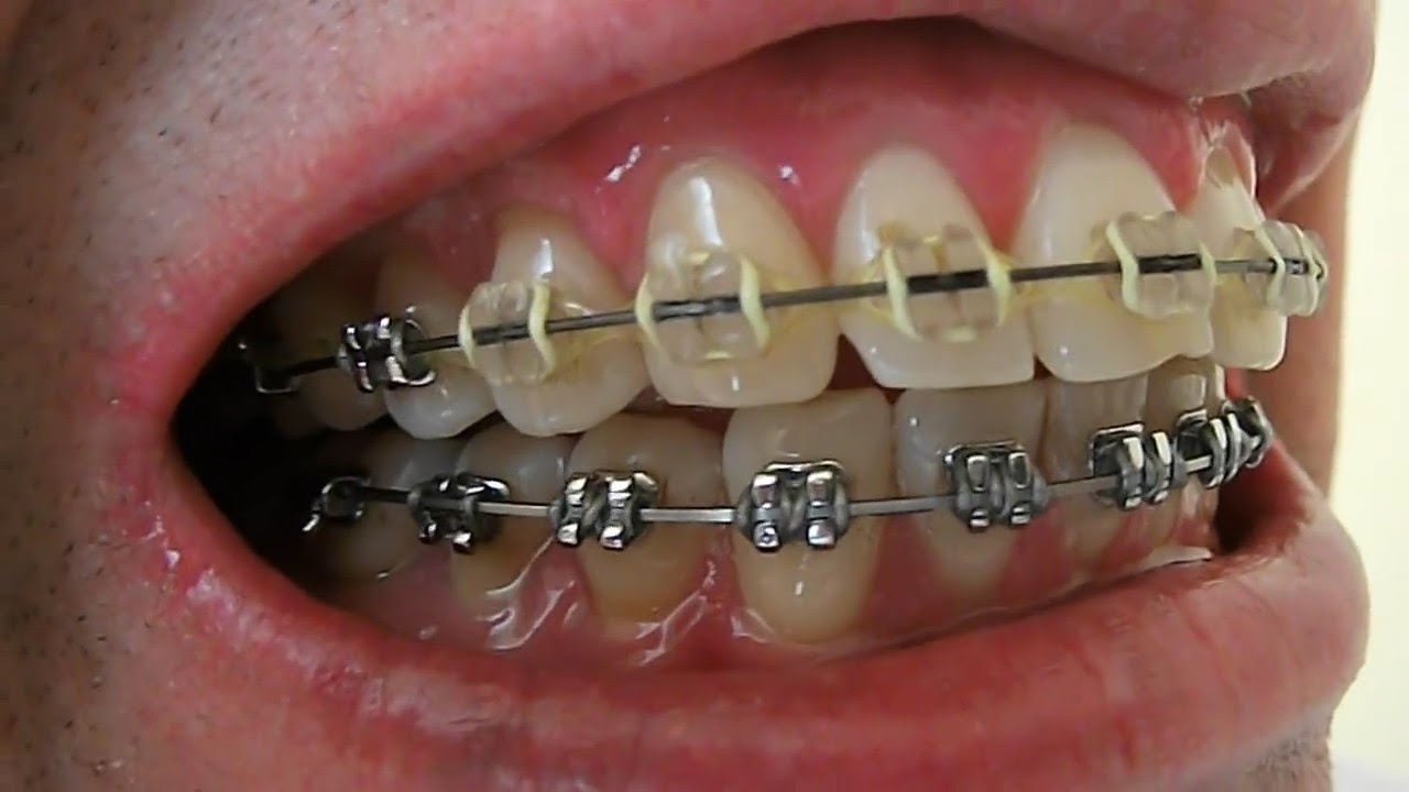 braces wire shifted to one side