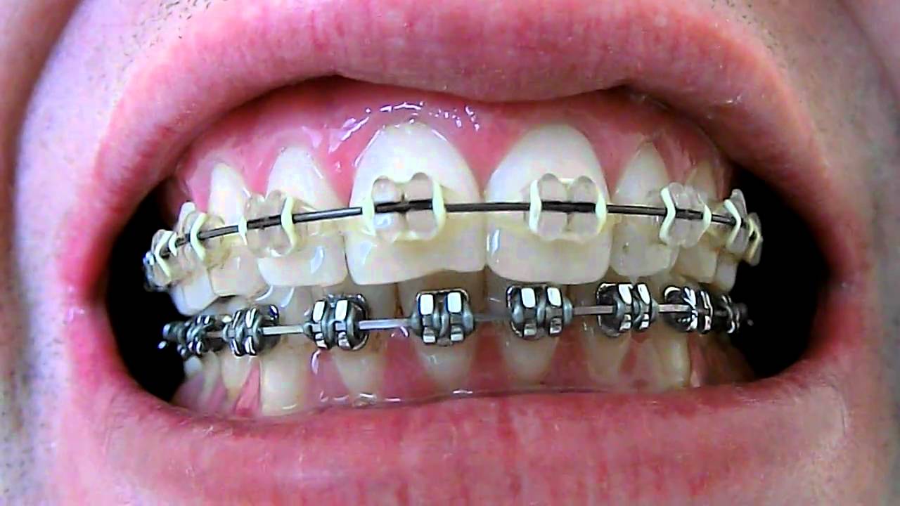 Braces with Black Finishing Wire - YouTube