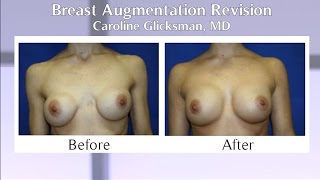 Breast Augmentation Revision - Surgeon Minute
