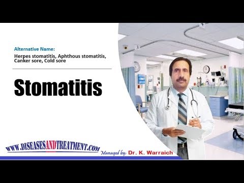 Stomatitis : Causes, Diagnosis, Symptoms, Treatment, Prognosis