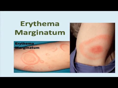 Video: Erythema Marginatum: Príčiny, Obrázok, Liečba A ďalšie