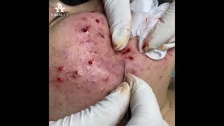 Squeezes acne super well | Dr Hưng S Beauty