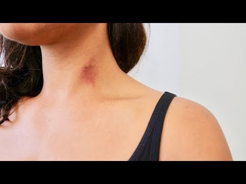 How To Get Rid Of A Hickey - How To Cover A Hickey