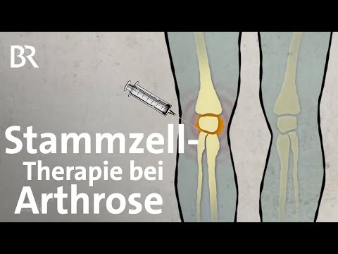 Video: Kann Die Stammzelltherapie Beschädigte Knie Reparieren?