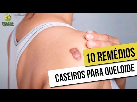 Vídeo: Como Se Livrar De Quelóides: Tratamentos E Remédios Caseiros