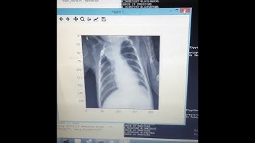 Covid-19 Corona Disease classification using Deep Learning
