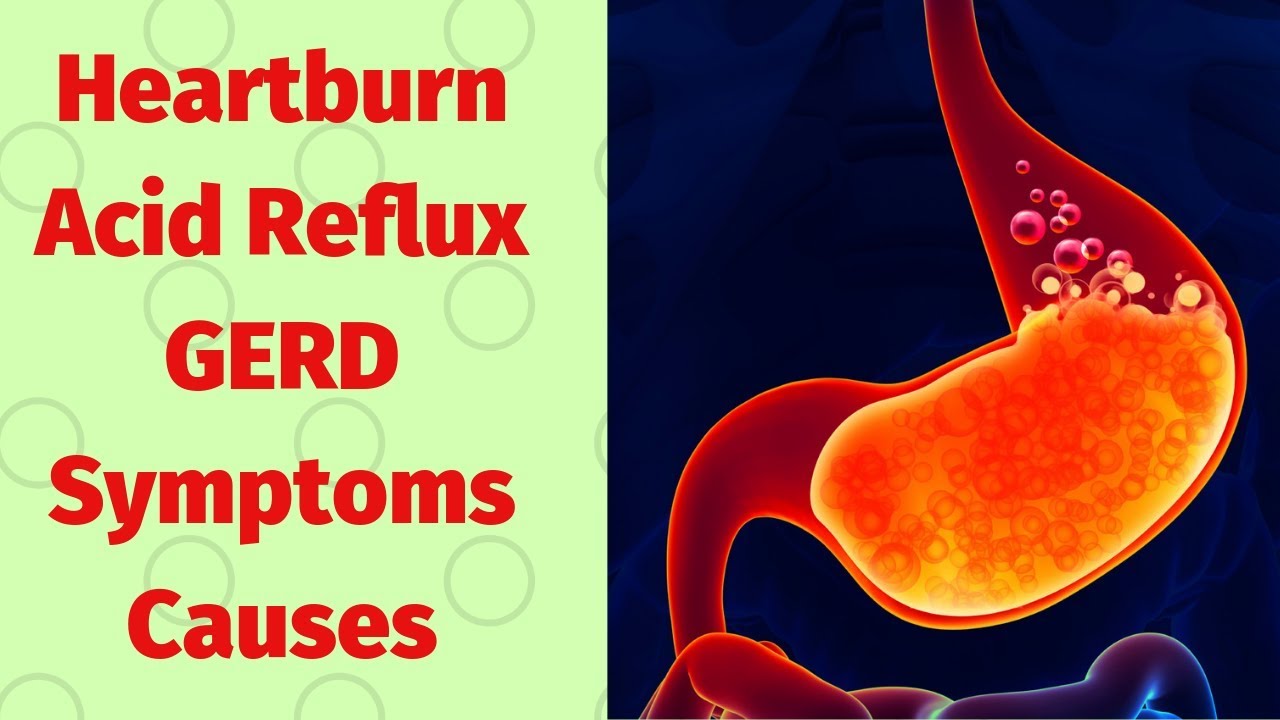 Heartburn, Acid Reflux, GERD : Symptoms, Causes - Natural ...