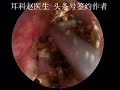 Cholesteatoma of the external auditory canal a month ago