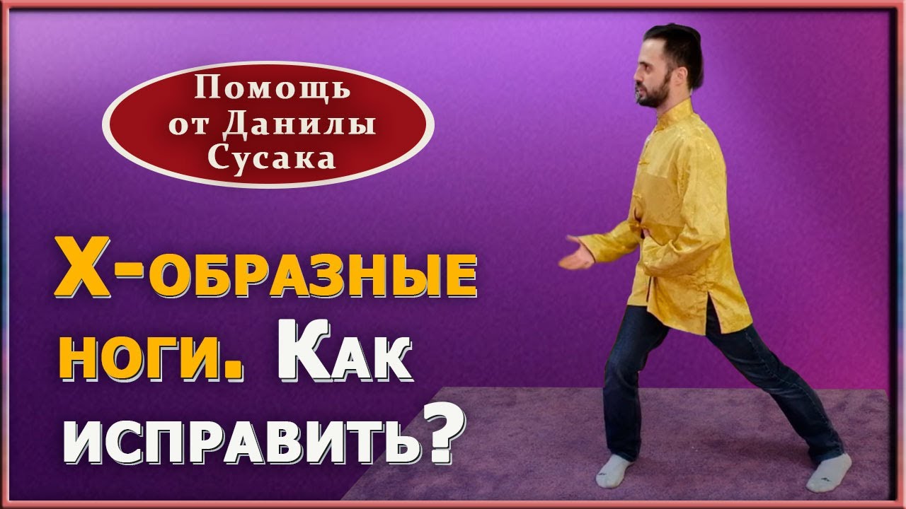 Вальгусная деформация ног, х-образные ноги. Упражнения для выпрямления ...