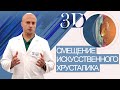 Дислокация ИОЛ (смещение искусственного хрусталика)