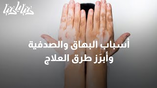 أسباب البهاق والصدفية وأبرَز طرق العلاج - دنيا يا دنيا