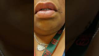 Part II Lip twitching