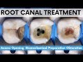 Root canal treatmentmandibular 2nd molaraccess opening biomechanical preparationobturation