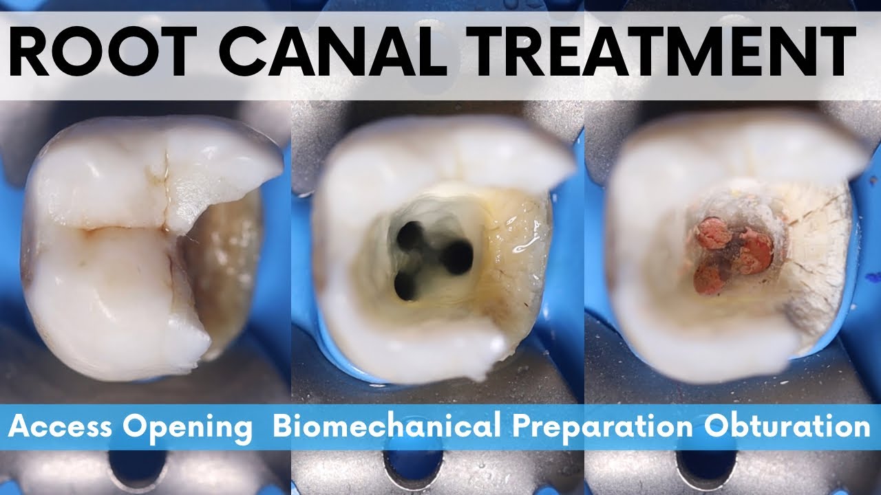 Root Canal Treatmentmandibular Nd Molaraccess Opening Biomechanical