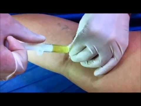 quiste+sinovial+rodilla+en+niños