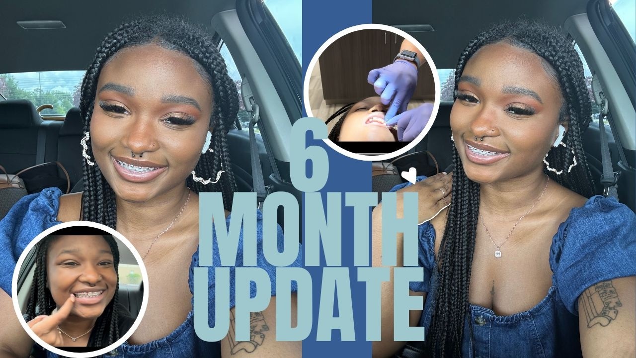 THE ARCHIVES: 6 MONTH BRACES UPDATE | FULL POWER CHAIN | JAMARI EREECE