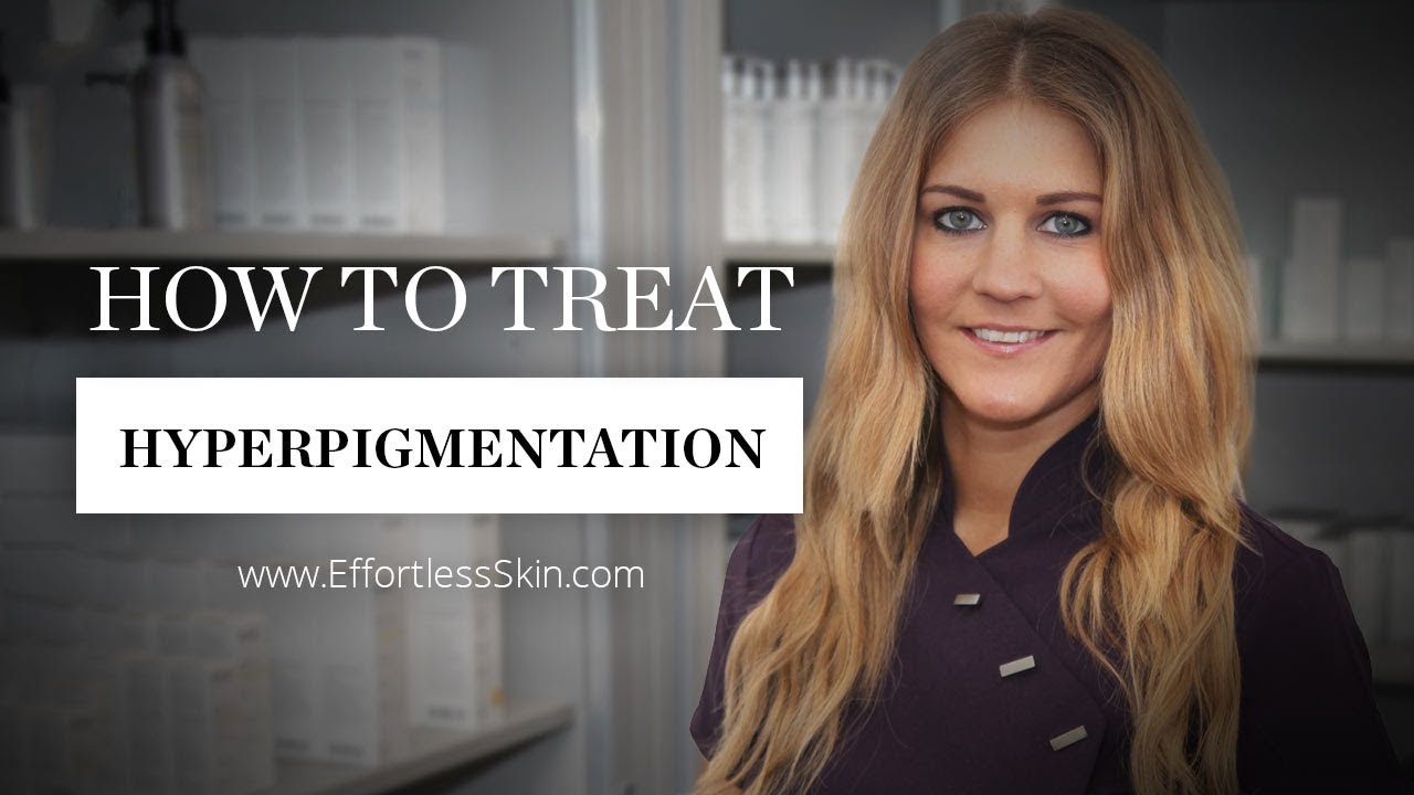 How To Treat Hyperpigmentation | How To Treat Dark Spots | Effortless ...