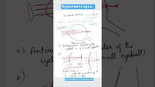 Hypermetropia