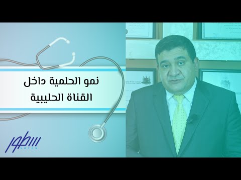 نمو الحلمية داخل القناة الحليبية 