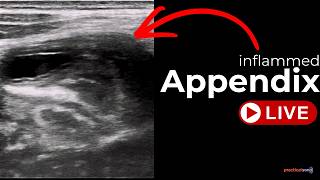 Normal Appendix Vs Appendicitis | Diagnostic Criteria
