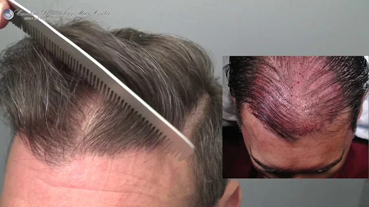Hair Transplant With 3149 Grafts by Dr. Cooley in ...