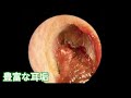 耳 掃除 アルコール - 耳かき 耳掃除 ピンセット - earwax #34