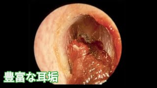 耳 掃除 アルコール - 耳かき 耳掃除 ピンセット - earwax #34