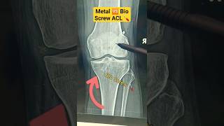 Bio 🆚 Metal ACL Screw | हड्डी में गलने वाला स्क्रू | #aclrecovery #aclinjury #acl#ligament  #bone