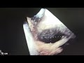 Sinus Venosus Superior ASD with Partial Anomalous Pulmonary Venous Drainage in 4D TEE