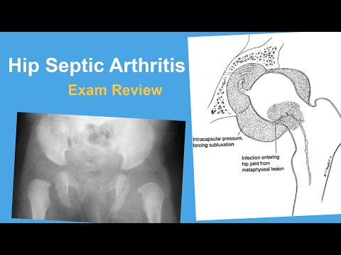 Hip Septic Arthritis Exam Review - Michael Glotzbecker, MD