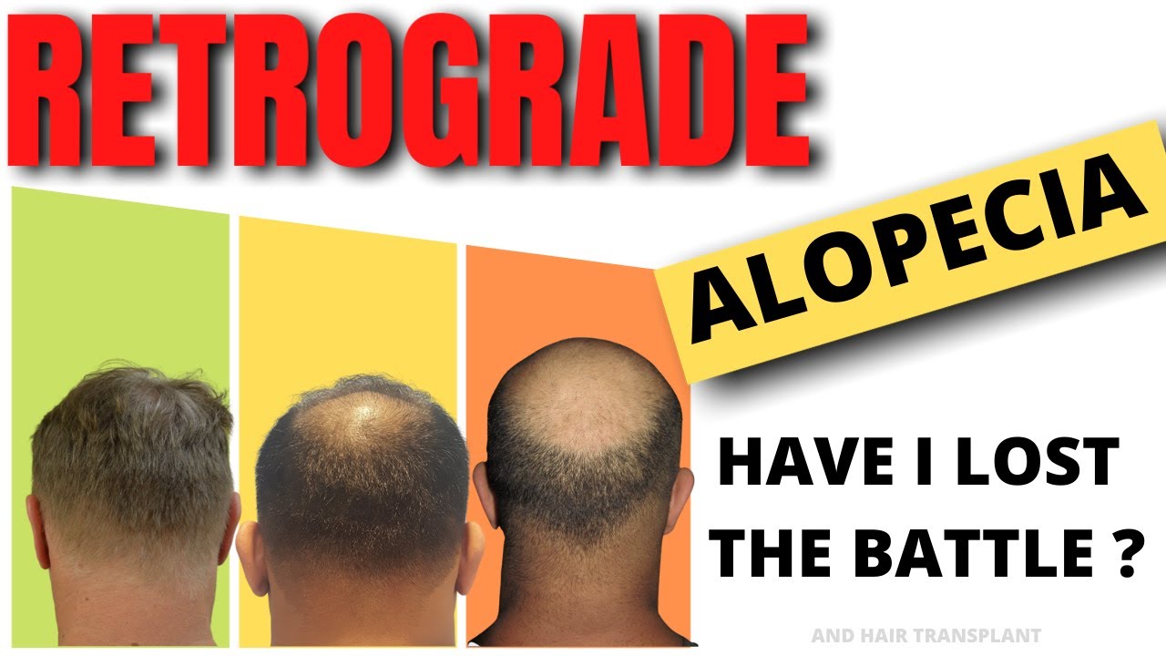 Retrograde alopecia & hair transplant Have I LOST the Hair Loss