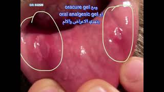 علاج القرحة الفمويه ( صور القرحه لمده ١٢ يوم لتوضيح ) طرق بسيطه للتخفيف الالم  Ulcer