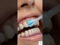 Whitening Process-Home vs Clinic #TeethWhitening #CosmeticDentistry #Whitening #DentalCare #Dental