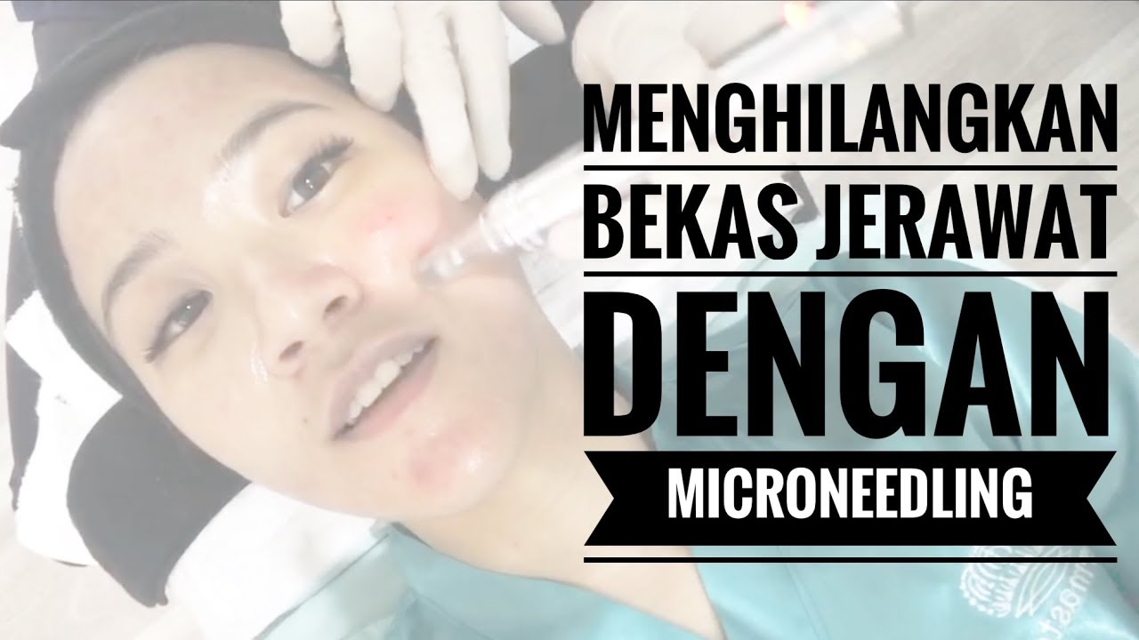 Cara Menghilangkan Bekas Jerawat Dengan Microneedling Youtube
