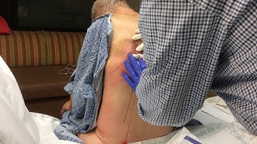 Aspirating a pleural empyema Part II