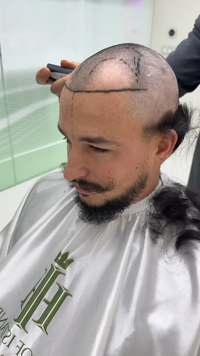 I got a hair transplant.