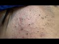 Tranquil Blackhead Removal and Skincare Routine ASMR