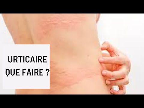 Urticaire : que