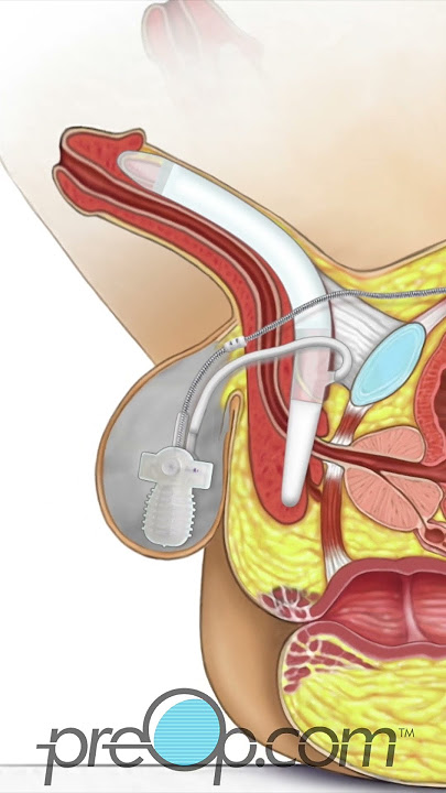 Inflatable Penile Implant -