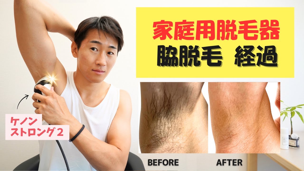 ケノン】家庭用光脱毛器で脇脱毛したリアルな経過・・・【ストロング2