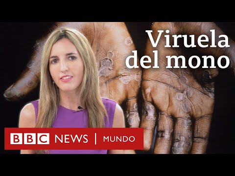 Cuáles son los síntomas y cómo se transmite la viruela del mono | BBC Mundo