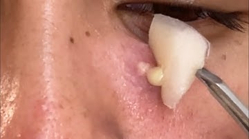 Pimple patches peel off.