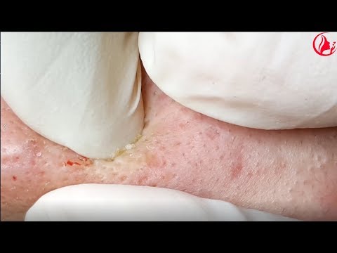 Video Cách điều trị mụn đầu đen, mụn ẩn, mụn cám - hiệu quả... - youtube