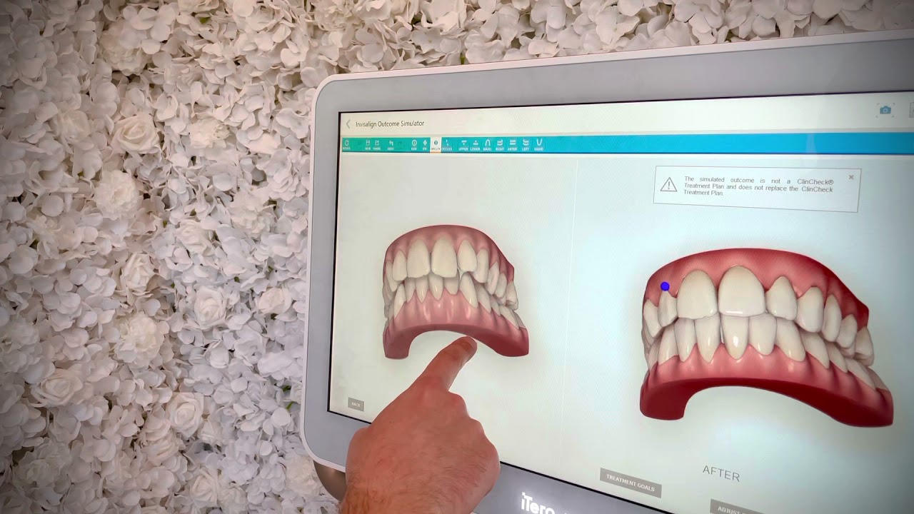 Invisalign smile simulation using Itero digital scanner